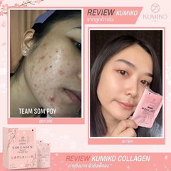 3 Box Kumiko Collagen Premium 150,000 mg Radiant Skin Whitening Youthful Vitamin