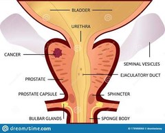 NEW Mejor tratamiento natural para desinflamar la prostata prostatitis